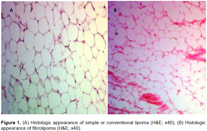 lipoma histology