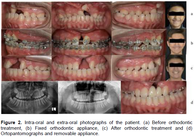 Journal of Dentistry and Oral Hygiene - interdisciplinary treatment  approaches for cleft lip and palate patients to obtain esthetic and  functional results