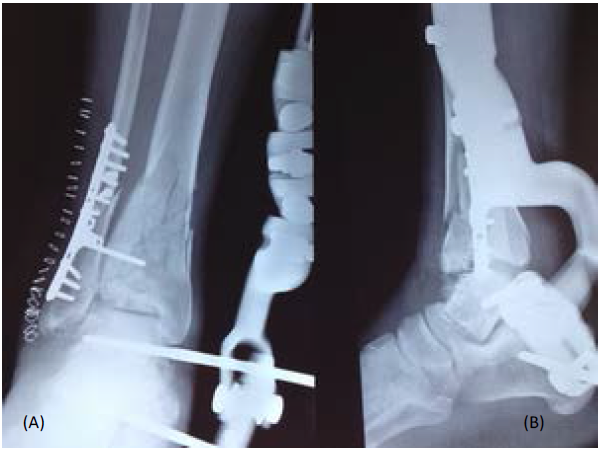 Full ring external fixation (Ilizarov) for Extraarticular, wedge fracture